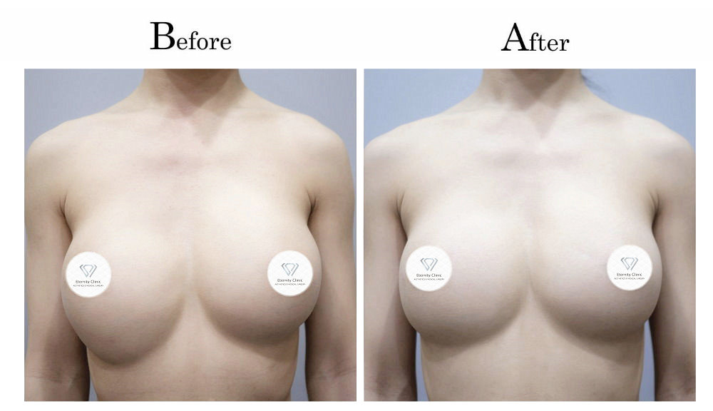 高雄隆乳失敗隆乳後胸部ㄧ高ㄧ低(高低胸)001