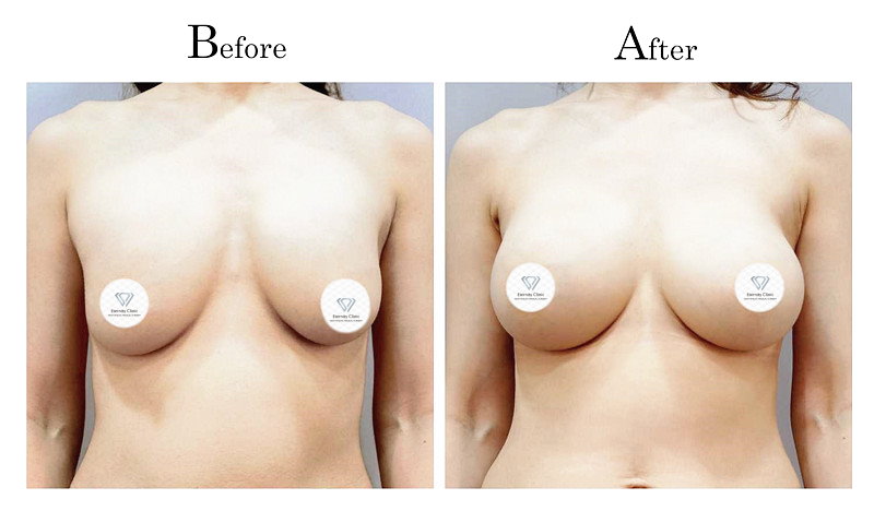 高雄隆乳失敗莢膜攣縮(石頭奶)001