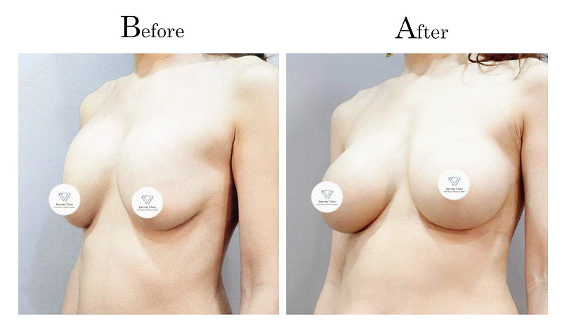 高雄隆乳失敗莢膜攣縮(石頭奶)002