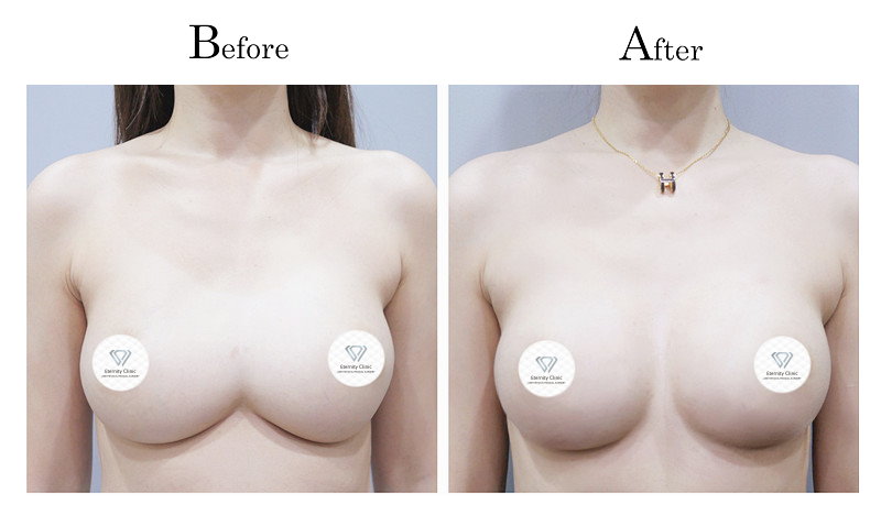 高雄隆乳失敗隆乳後造成兩乳房連在一起(連通奶)001