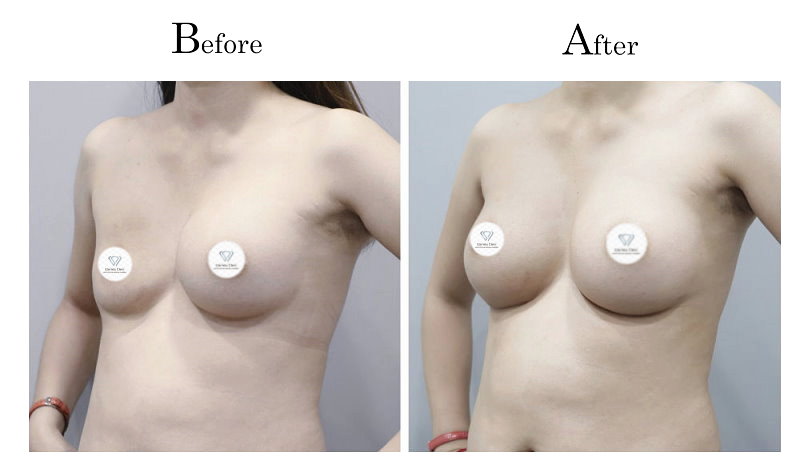 高雄隆乳失敗假體破裂02