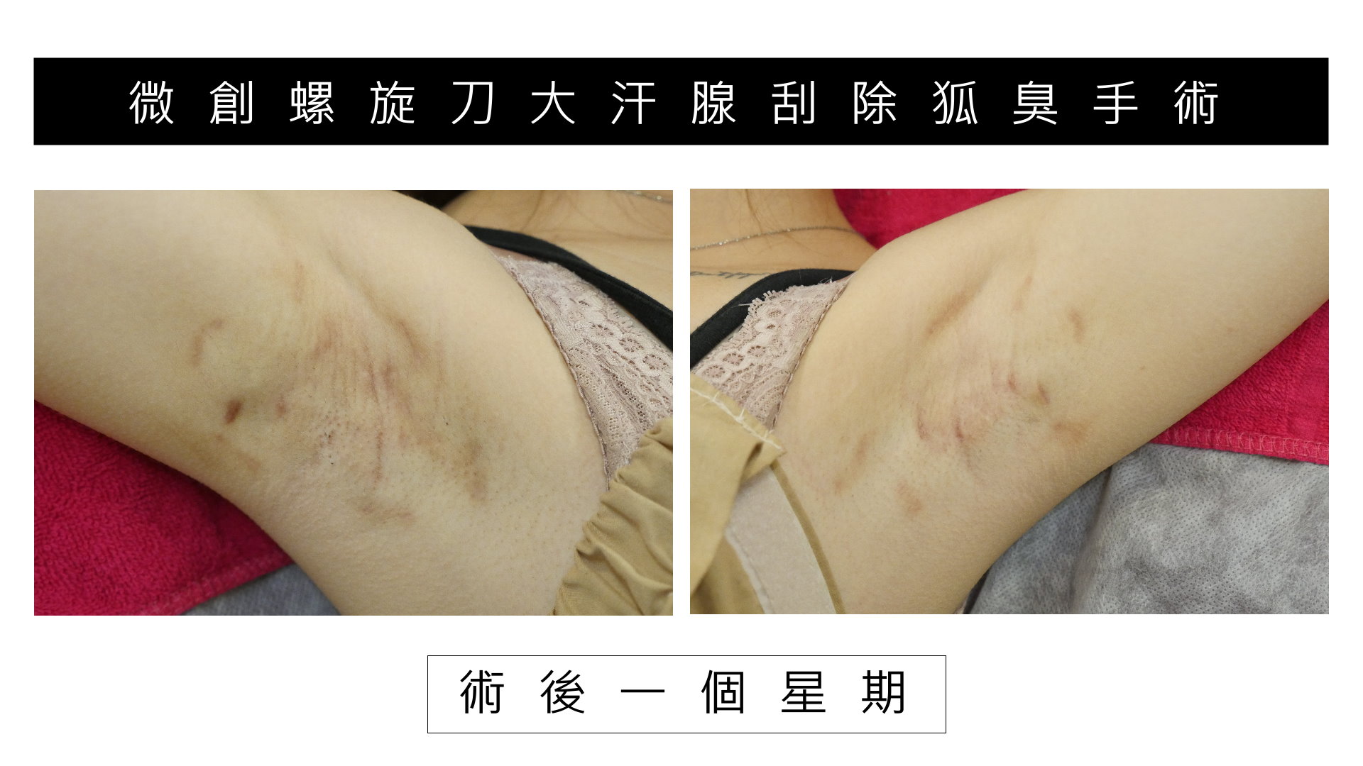台南狐臭手術價格費用,除狐臭手術推薦醫師02