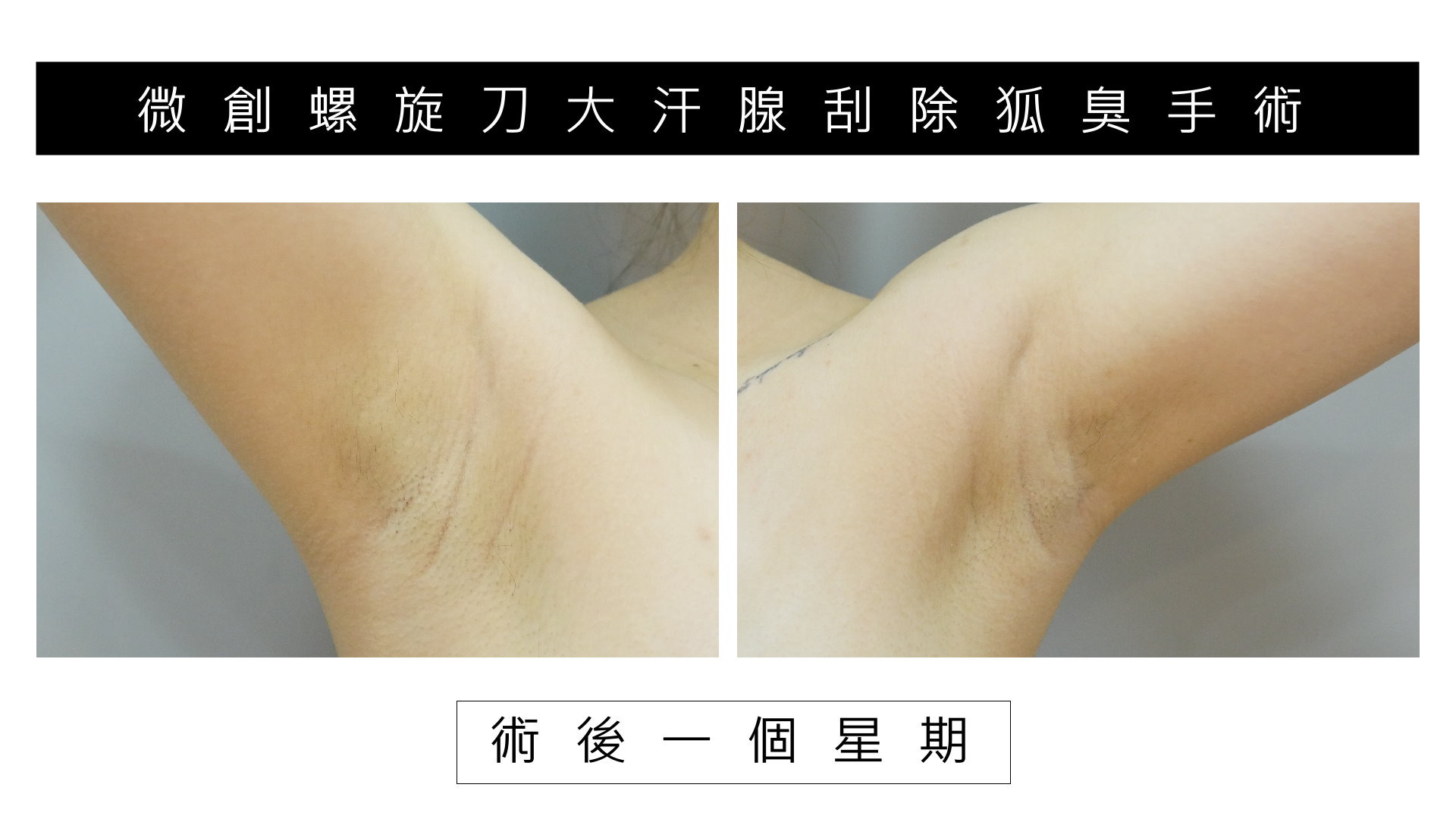 台南狐臭手術價格費用,除狐臭手術推薦醫師03