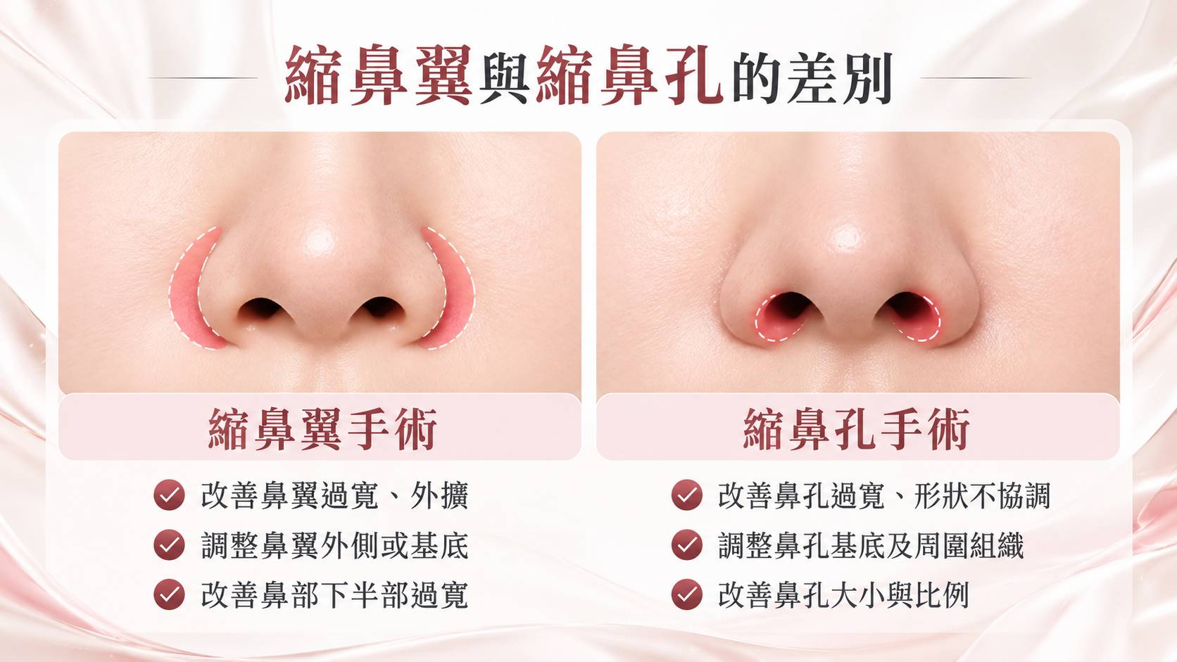 台南縮鼻翼縮鼻孔手術權威醫師推薦價格費用多少006